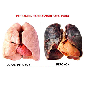 Penyakit berbahaya akibat merokok