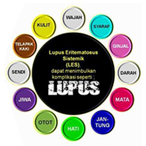 Obat Herbal Lupus