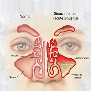 Penyebab Sinuitis