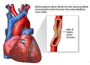 Obat Jantung Koroner
